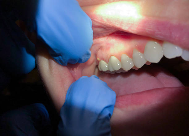 Best Emergency Wisdom Teeth Removal in Forest Acres, SC
